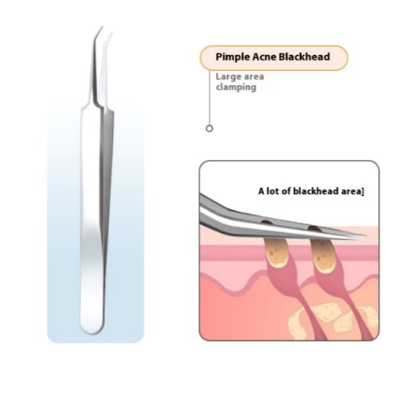 Whiteheads Blackheads Acne Clip Tweezers Mask Queen Nepal