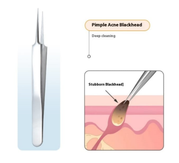 Whiteheads Blackheads Acne Clip Tweezers Mask Queen Nepal