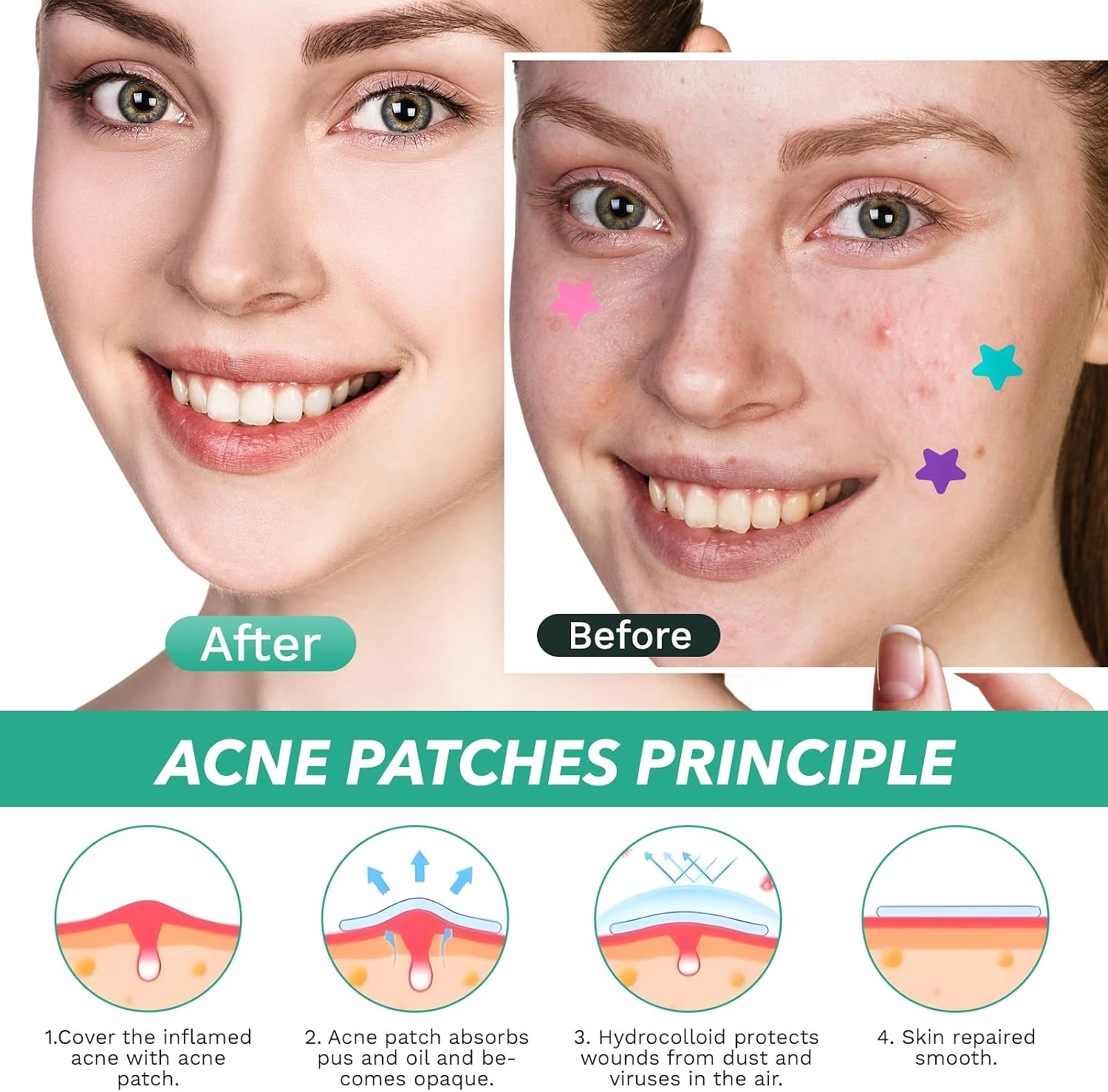 Star Shaped Pimple Patch (200 Counts) Easy Beauty Nepal
