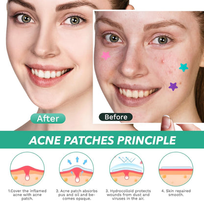 Star Shaped Pimple Patch (200 Counts) Easy Beauty Nepal