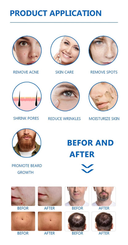 3 in 1 Derma Roller for Face Derma Roller With Titanium Needle Mask Queen Nepal